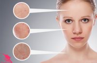 Nám da và cách chữa trị phổ biến nhất hiện nay